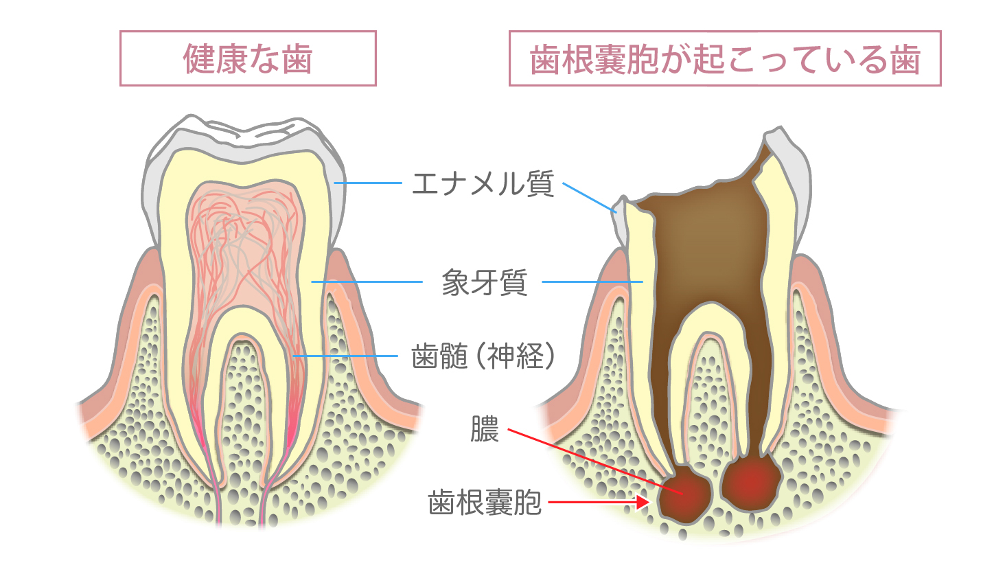 歯根嚢胞の説明図