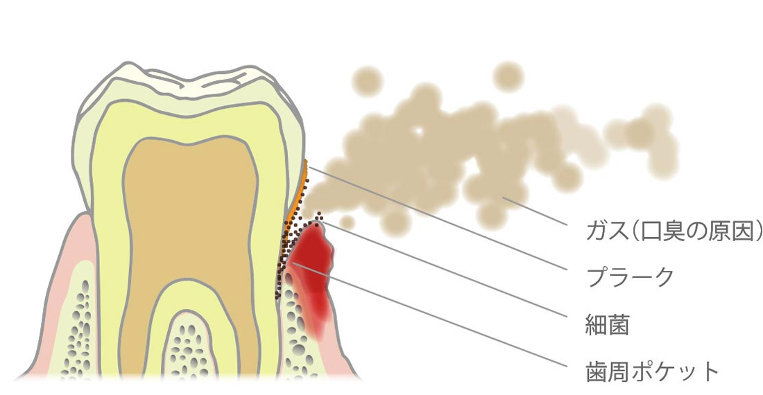 歯周病による口臭のメカニズム