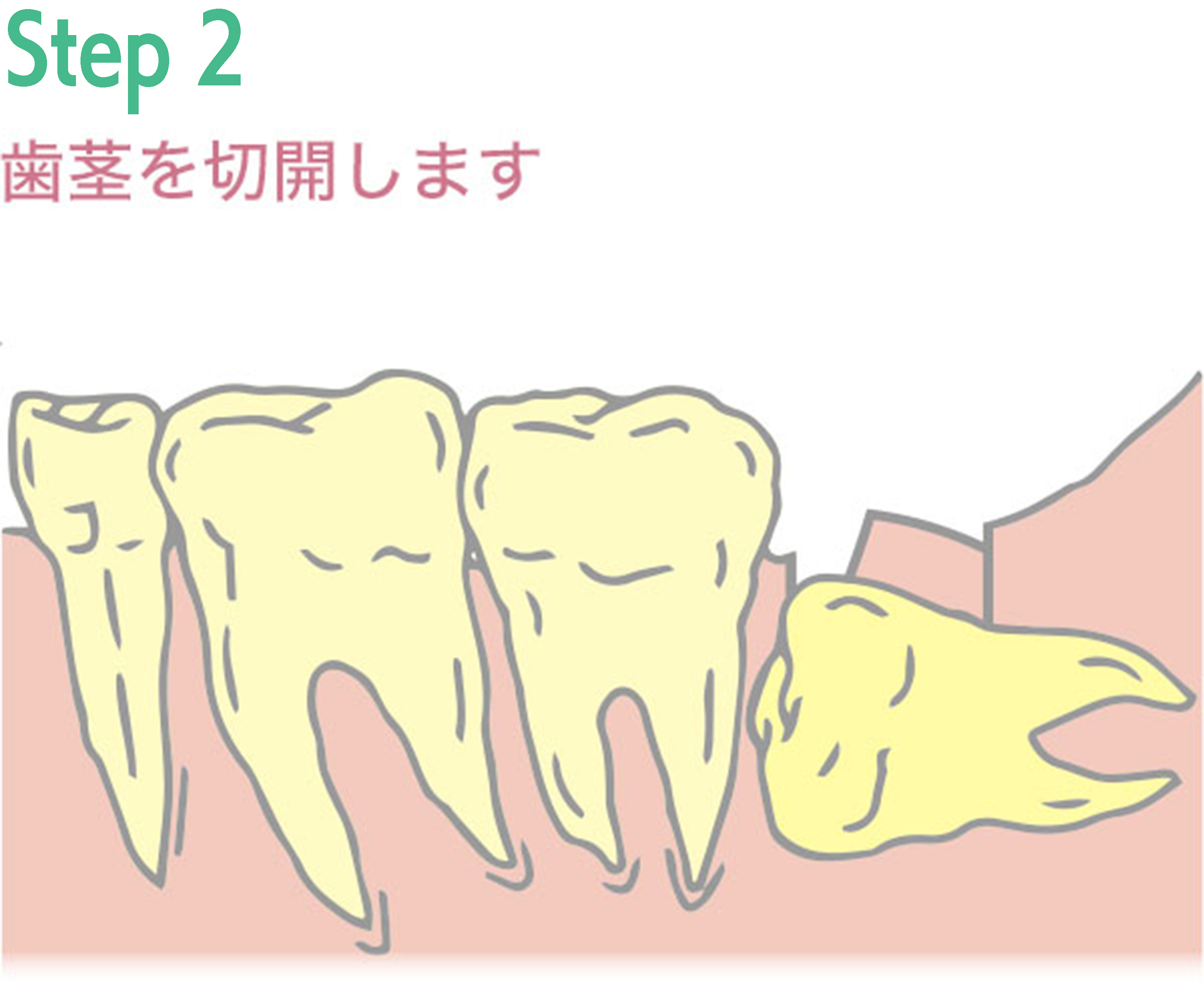 親知らず抜歯手術の例2