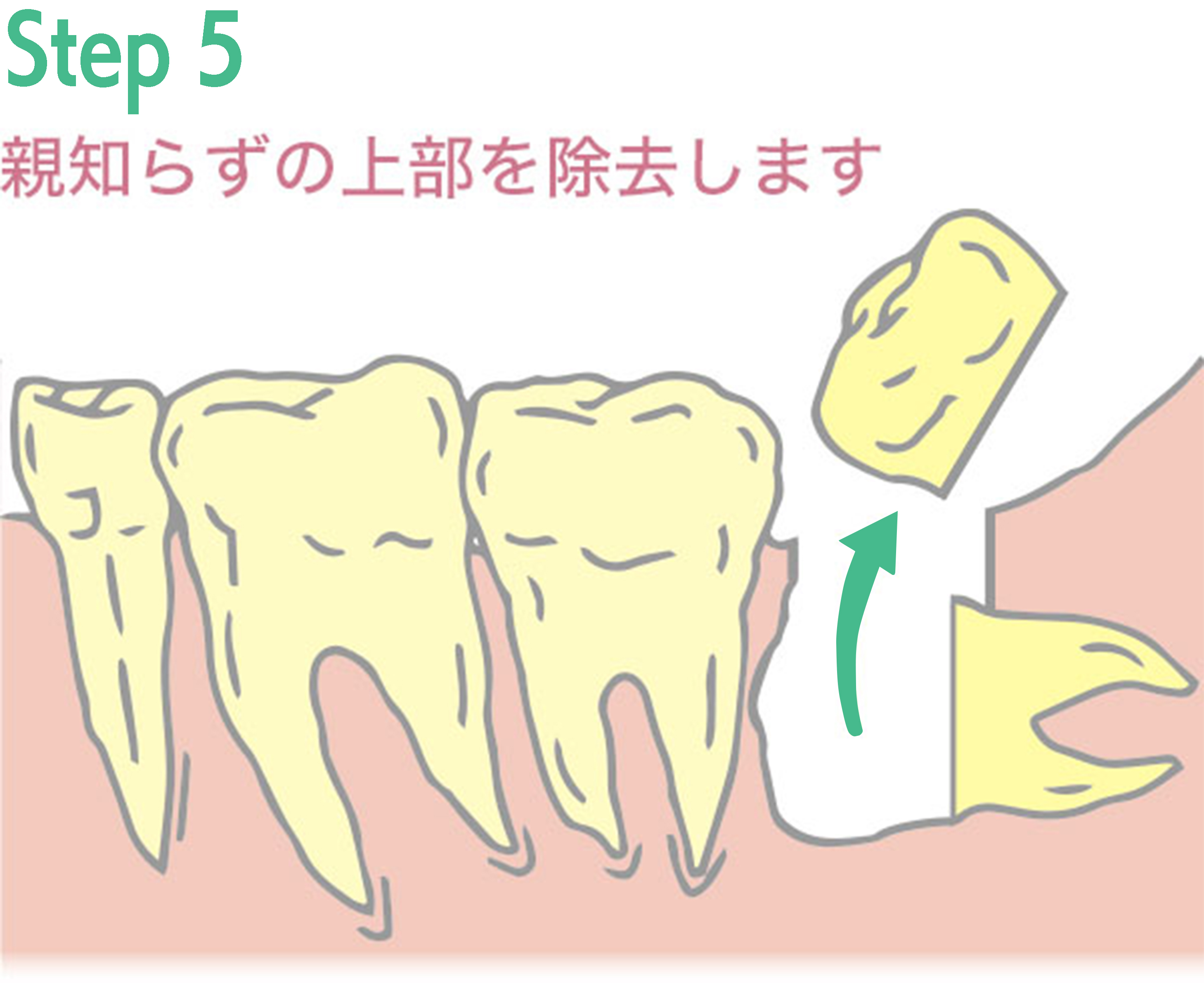 親知らず抜歯手術の例5