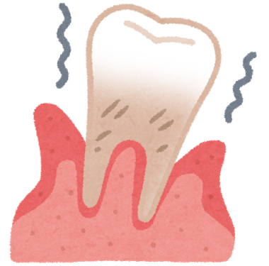 歯周病の歯と歯茎のイラスト