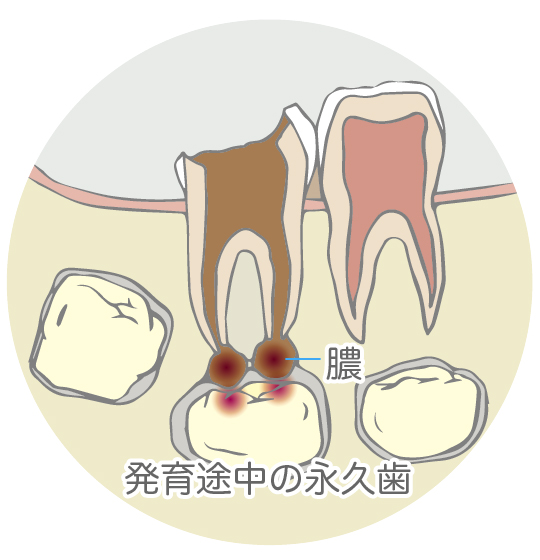 永久歯の発育を妨げる