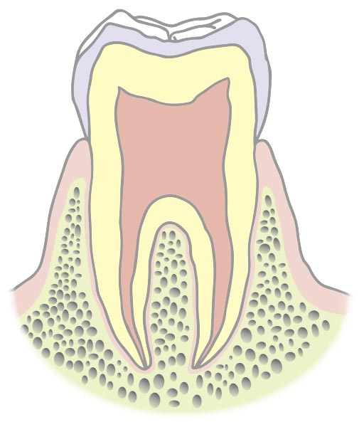 C0（むし歯の前段階）
