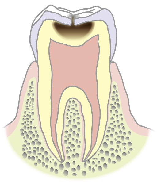 C2（象牙質のむし歯）