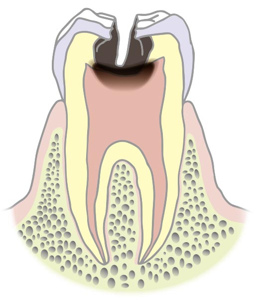 C3（歯髄まで進行したむし歯）