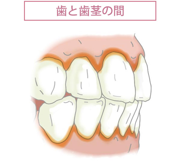 歯と歯茎の間