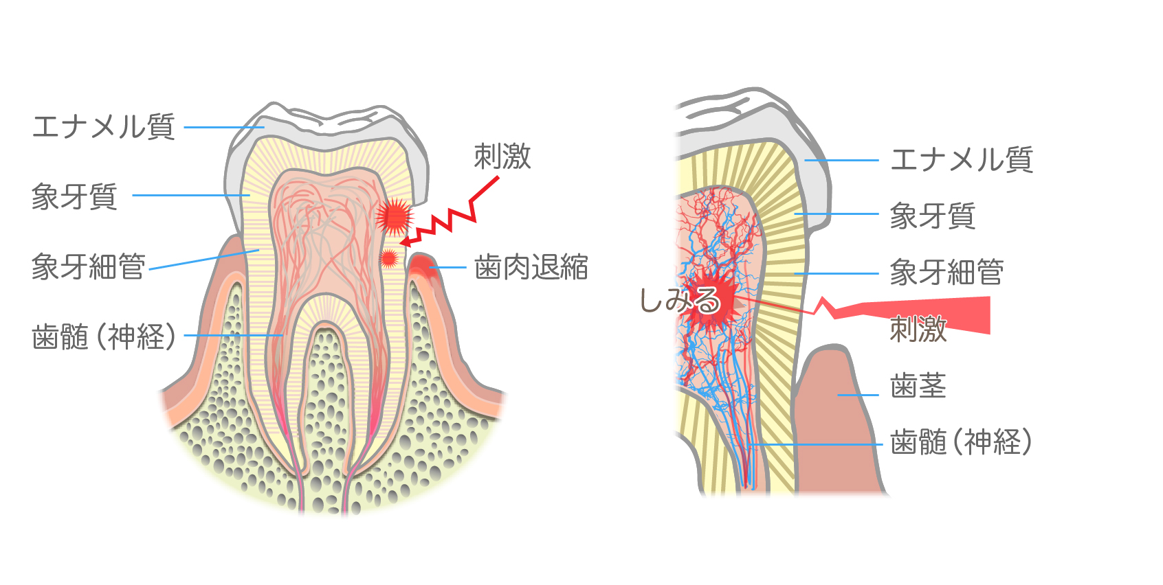 歯根嚢胞の説明図