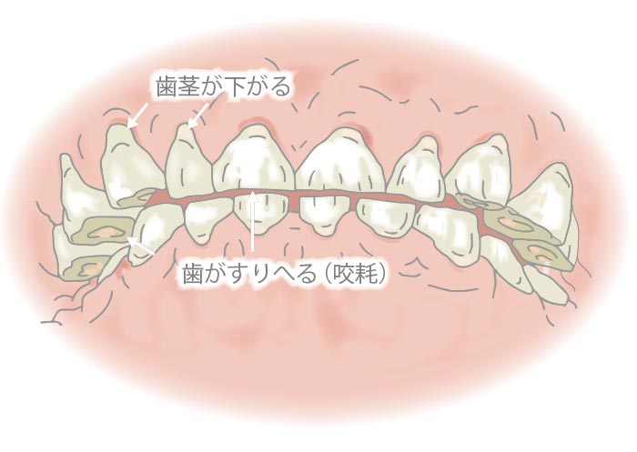 歯ぎしりによる悪影響 歯の咬み合う面がすり減ってしまう