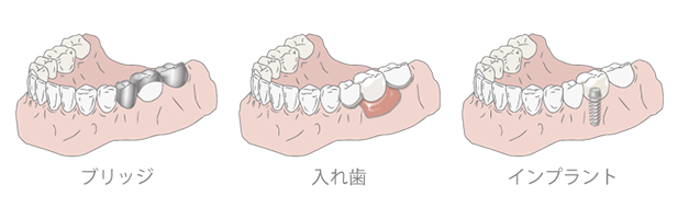 永久歯の虫歯