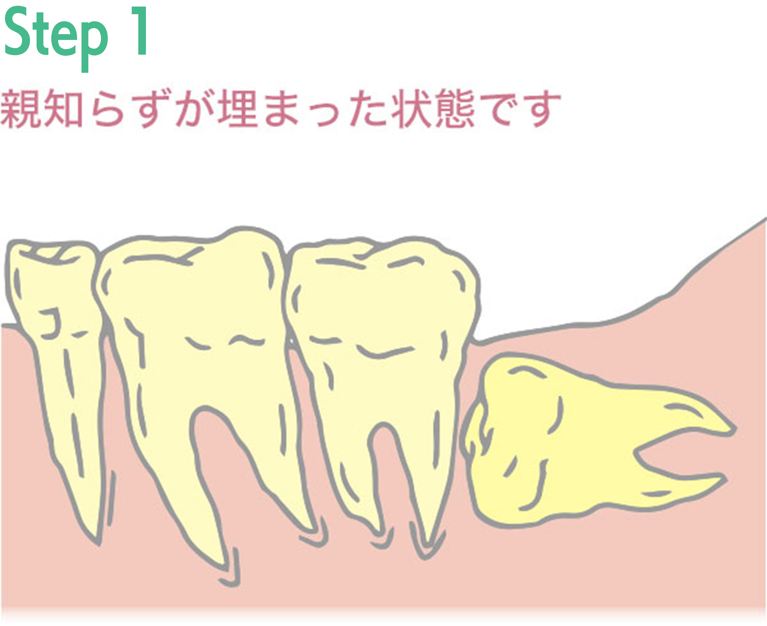 親知らず抜歯手術の例1