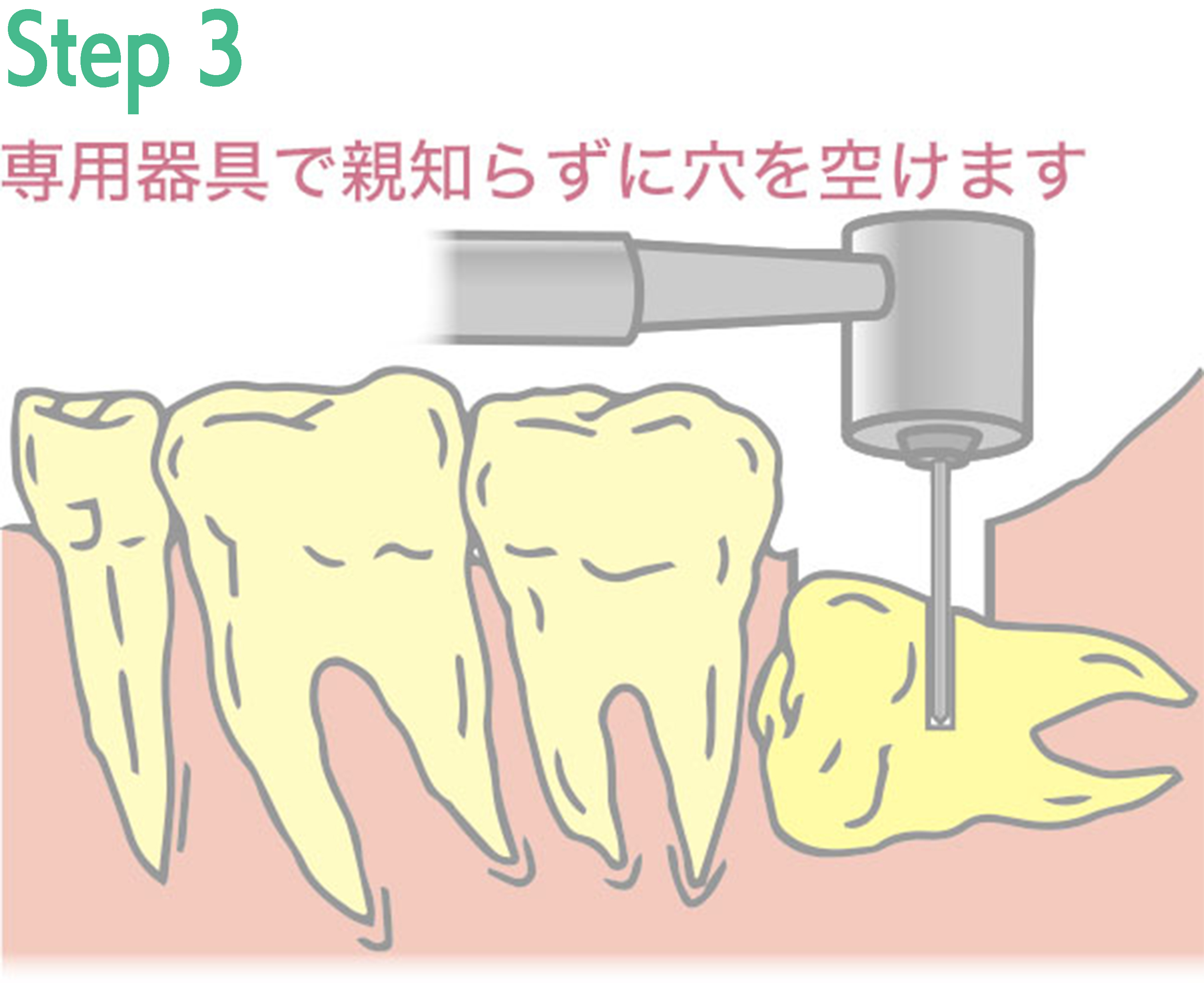 親知らず抜歯手術の例3
