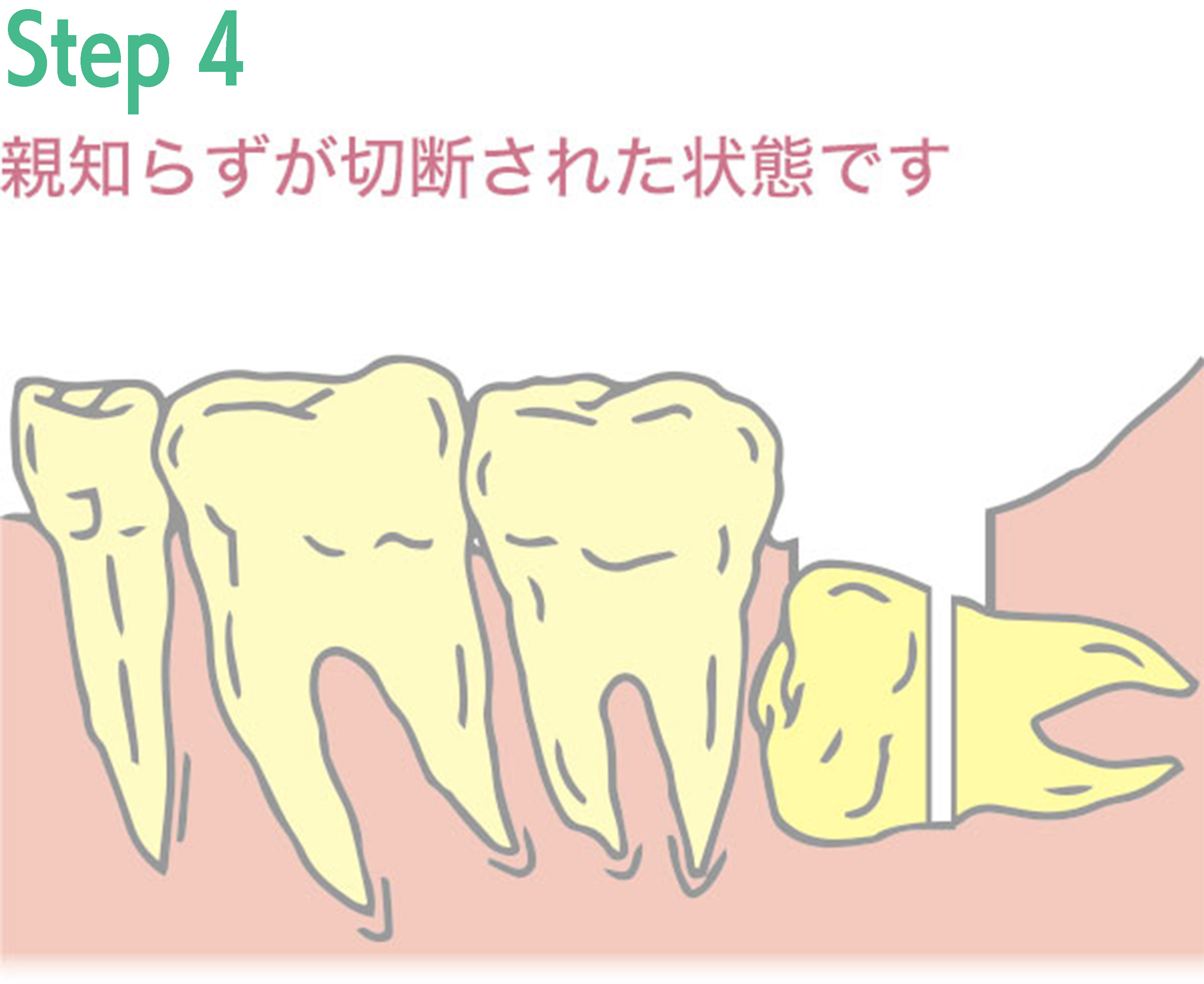 親知らず抜歯手術の例4