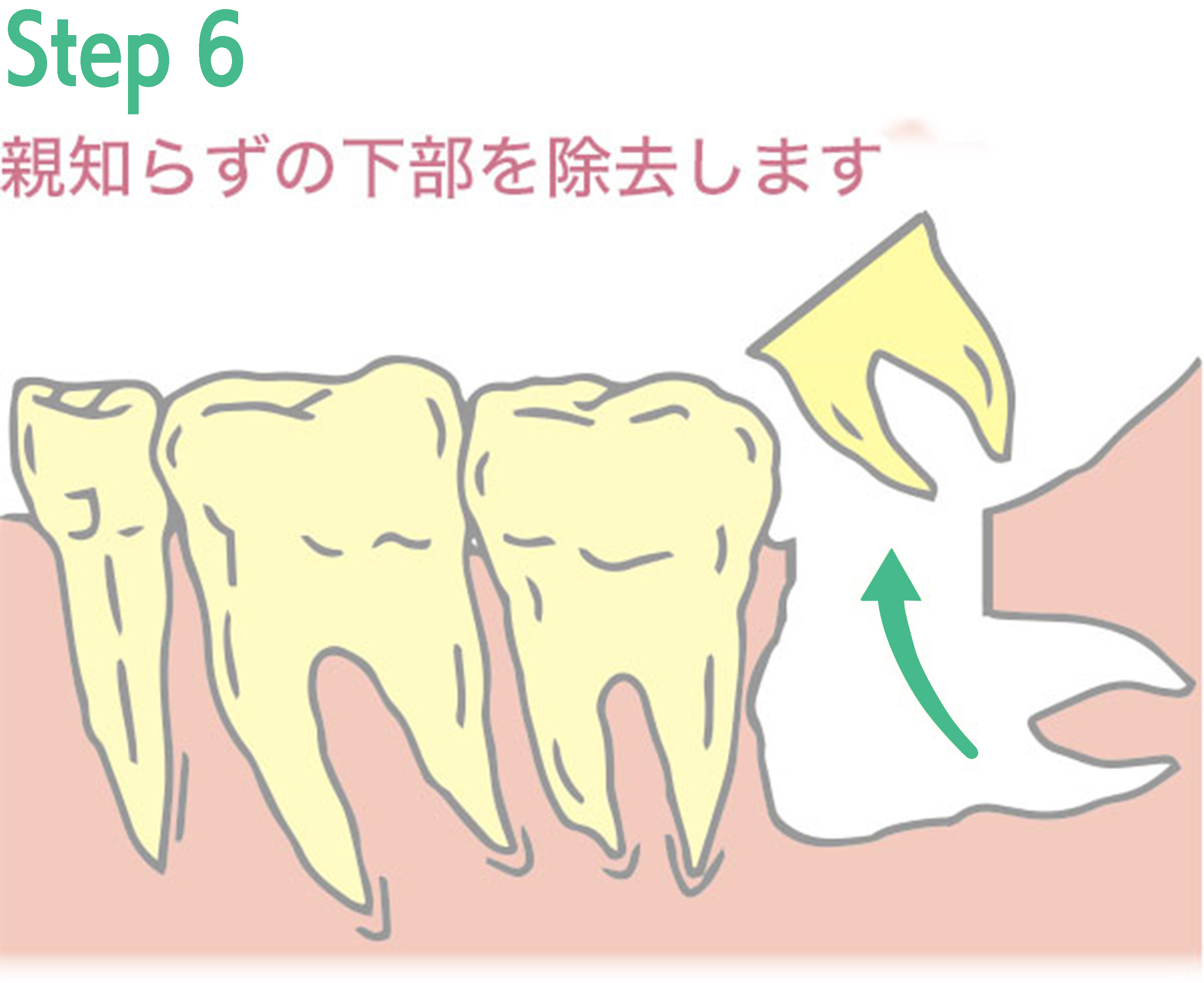 親知らず抜歯手術の例6